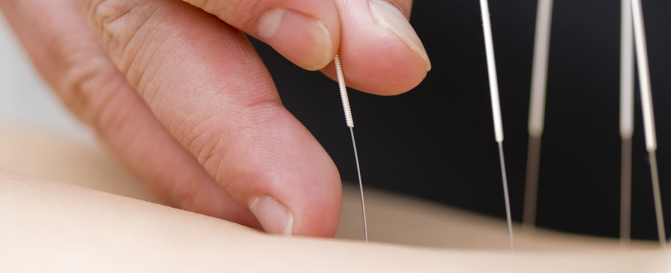 Practitioner placing an acupuncture needle