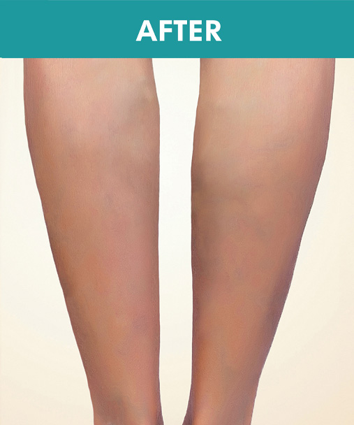 Leg comparison photograph labeled After