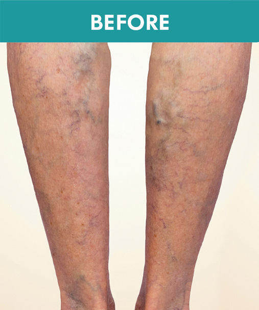 Legs with visible veins in a comparison photograph labeled Before
