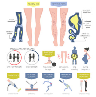 Infographic illustrating varicose veins, symptoms and treatment methods