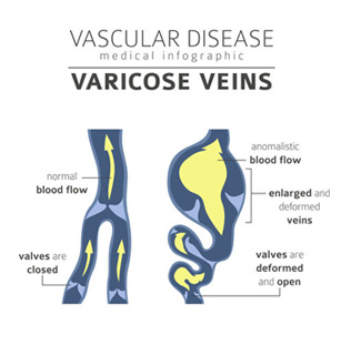 Diagram comparing normal and varicose veins and their blood flow
