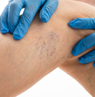 Gloved hands examining visible veins on a leg